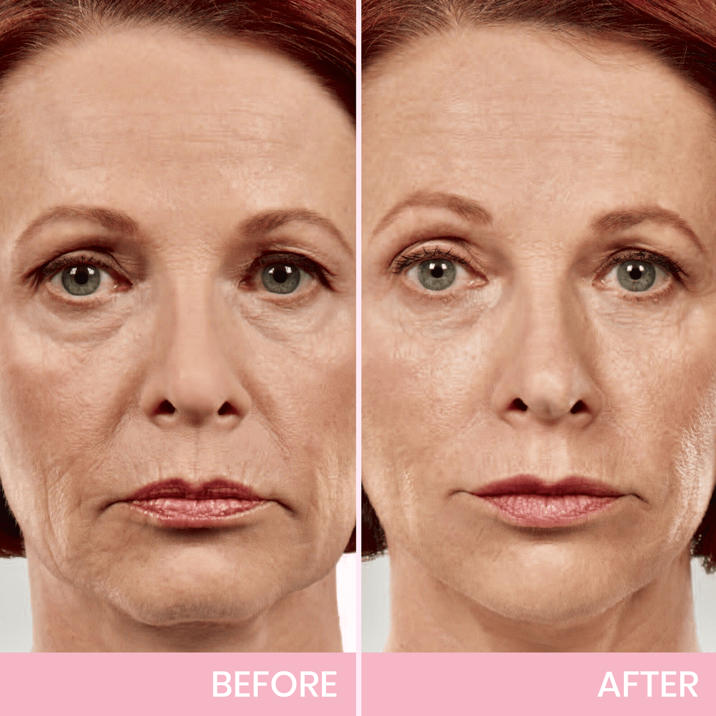 V-Face Lifting Invisible Adhesive Tape 10