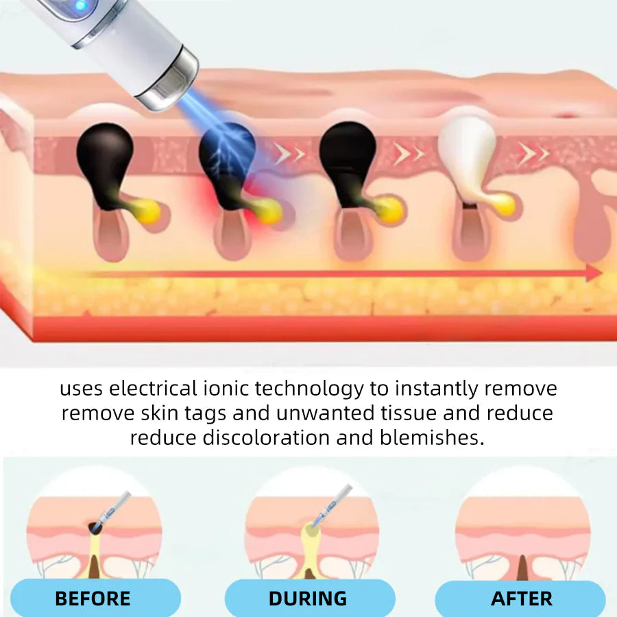 Aprolo™ Non-invasive Mole and Wart Removal Laser Pen