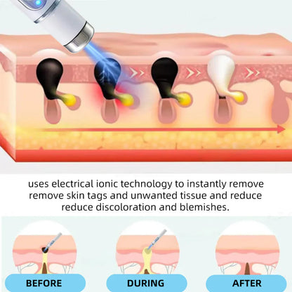 Aprolo™ Non-invasive Mole and Wart Removal Laser Pen