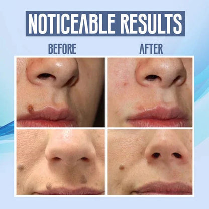 Spotfree Electric Beauty Pen