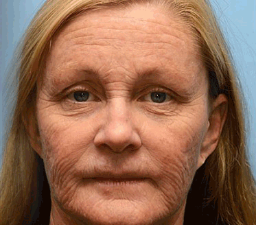 Botox & Retinol Shot | Eraser for deep wrinkles