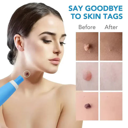 AutoSkin Tag Remover Kit - No More Skin Tags