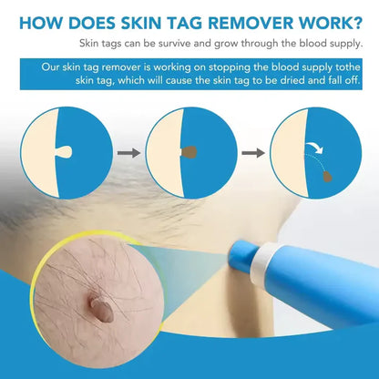 AutoSkin Tag Remover Kit - No More Skin Tags
