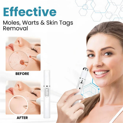 Aprolo™ Non-invasive Mole and Wart Removal Laser Pen