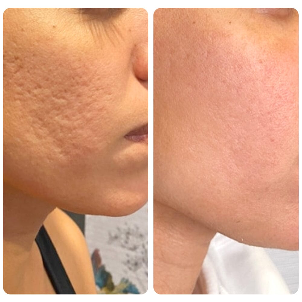 flysmus™ Dr.Treat PockmarksHeal Collagen 0.5mm Dermaroller