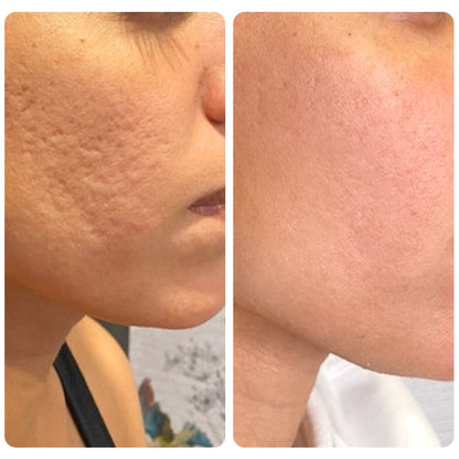 flysmus™ Dr.Treat PockmarksHeal Collagen 0.5mm Dermaroller