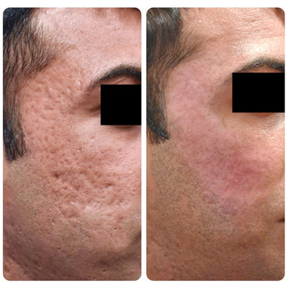 flysmus™ Dr.Treat PockmarksHeal Collagen 0.5mm Dermaroller