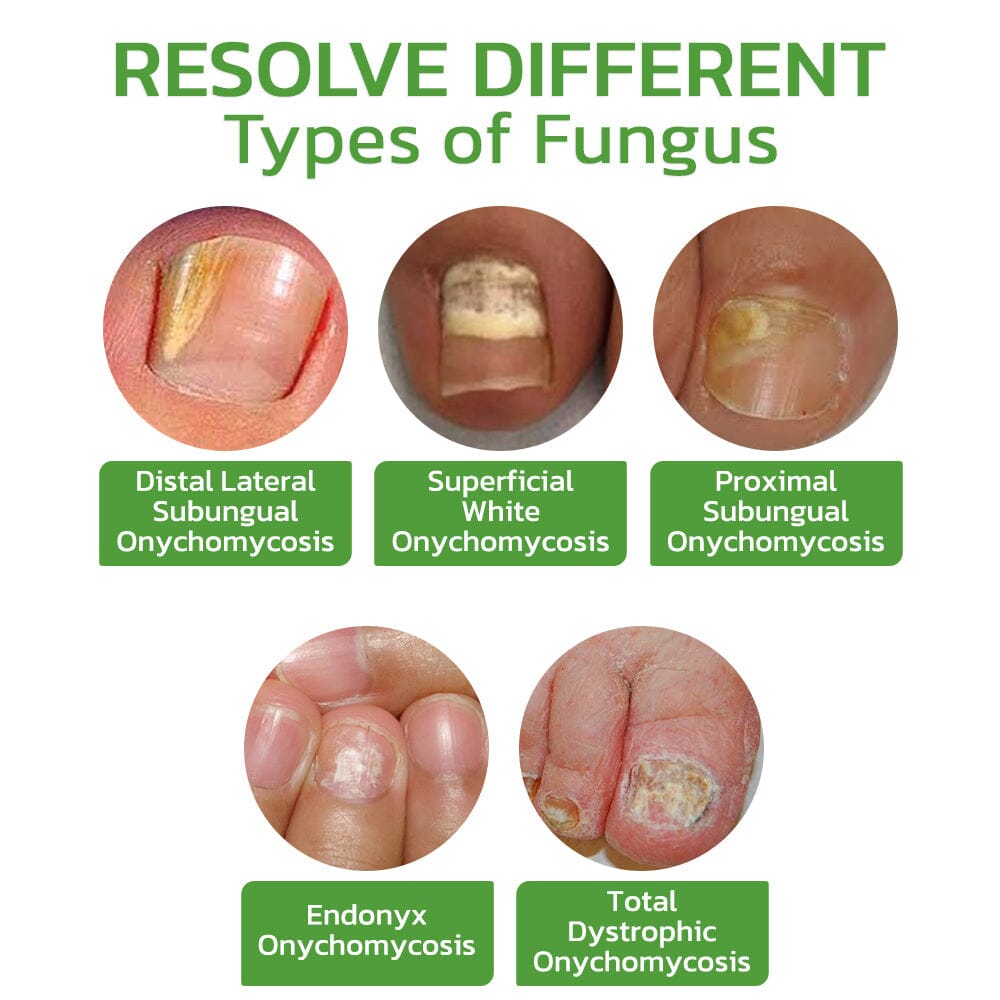 GFOUK™ 5 Days Nail Growth and Hardening Repair Roller